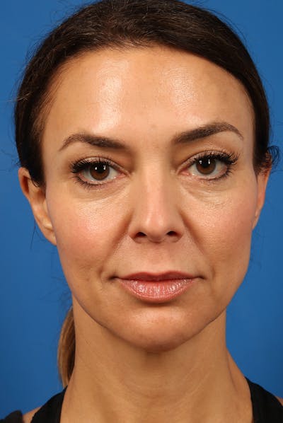 Chin Before & After Gallery - Patient 175499 - Image 2