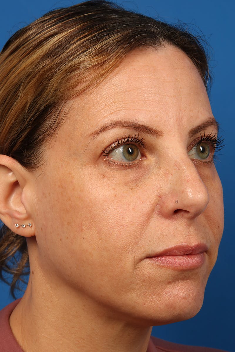 Full Face Before & After Gallery - Patient 284190 - Image 3