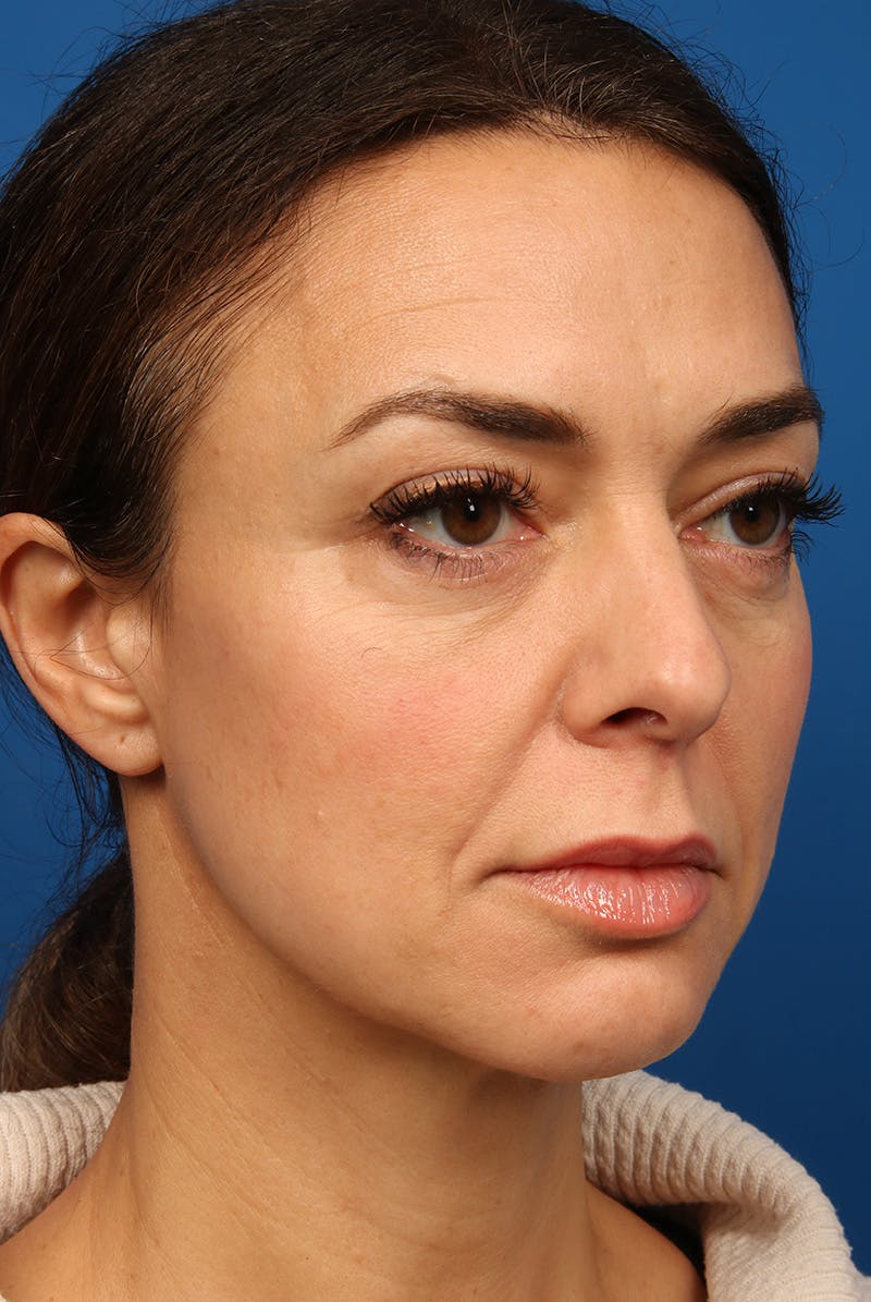 Cheeks Before & After Gallery - Patient 170223 - Image 3