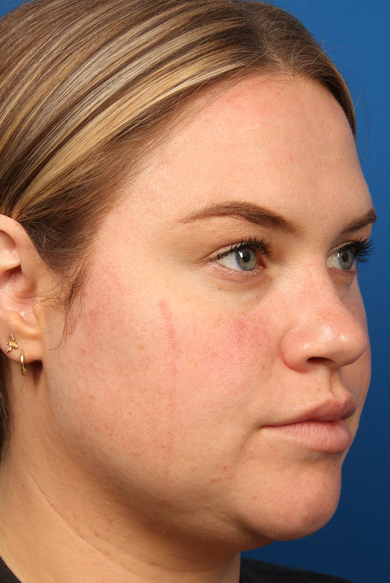 Tear Troughs Before & After Gallery - Patient 216553 - Image 3