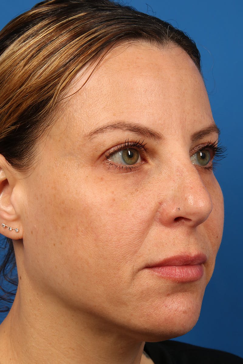 Full Face Before & After Gallery - Patient 284190 - Image 4