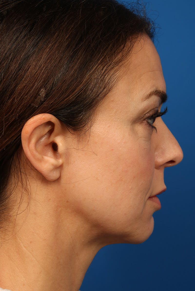 Cheeks Before & After Gallery - Patient 170223 - Image 5