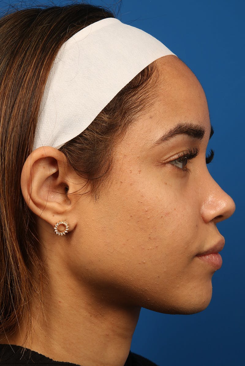 Tear Troughs Before & After Gallery - Patient 301103 - Image 5