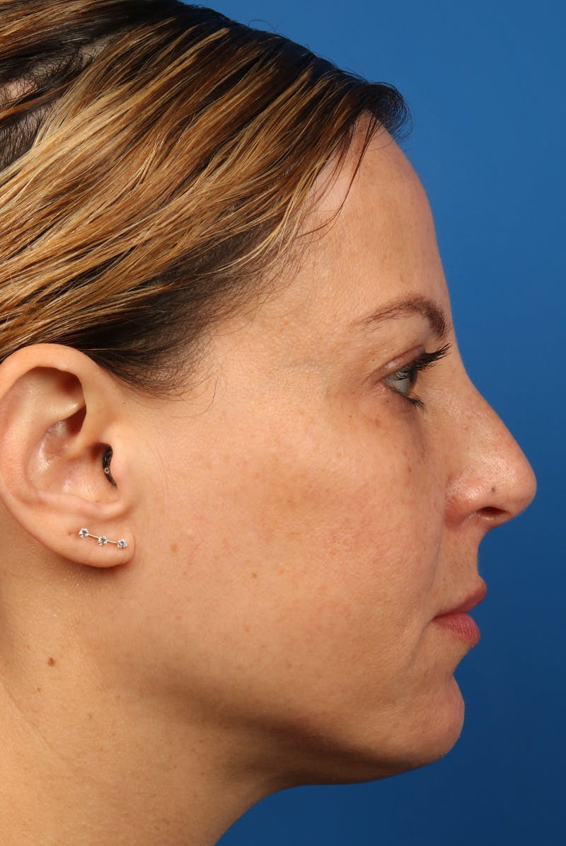 Full Face Before & After Gallery - Patient 284190 - Image 6