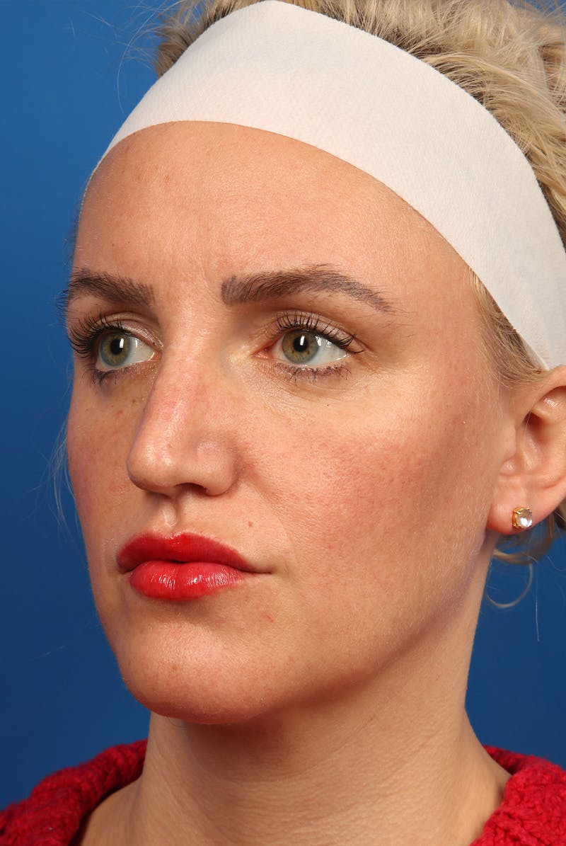 Nose Before & After Gallery - Patient 463536 - Image 7