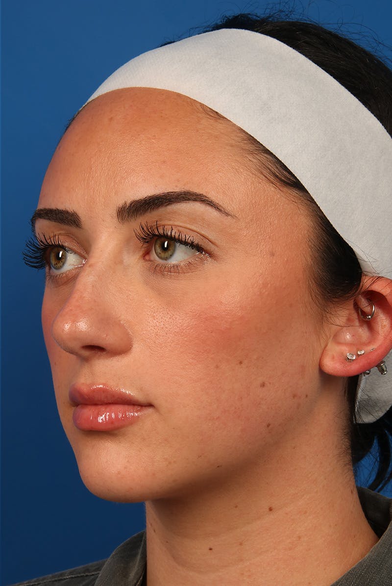 Tear Troughs Before & After Gallery - Patient 349942 - Image 8