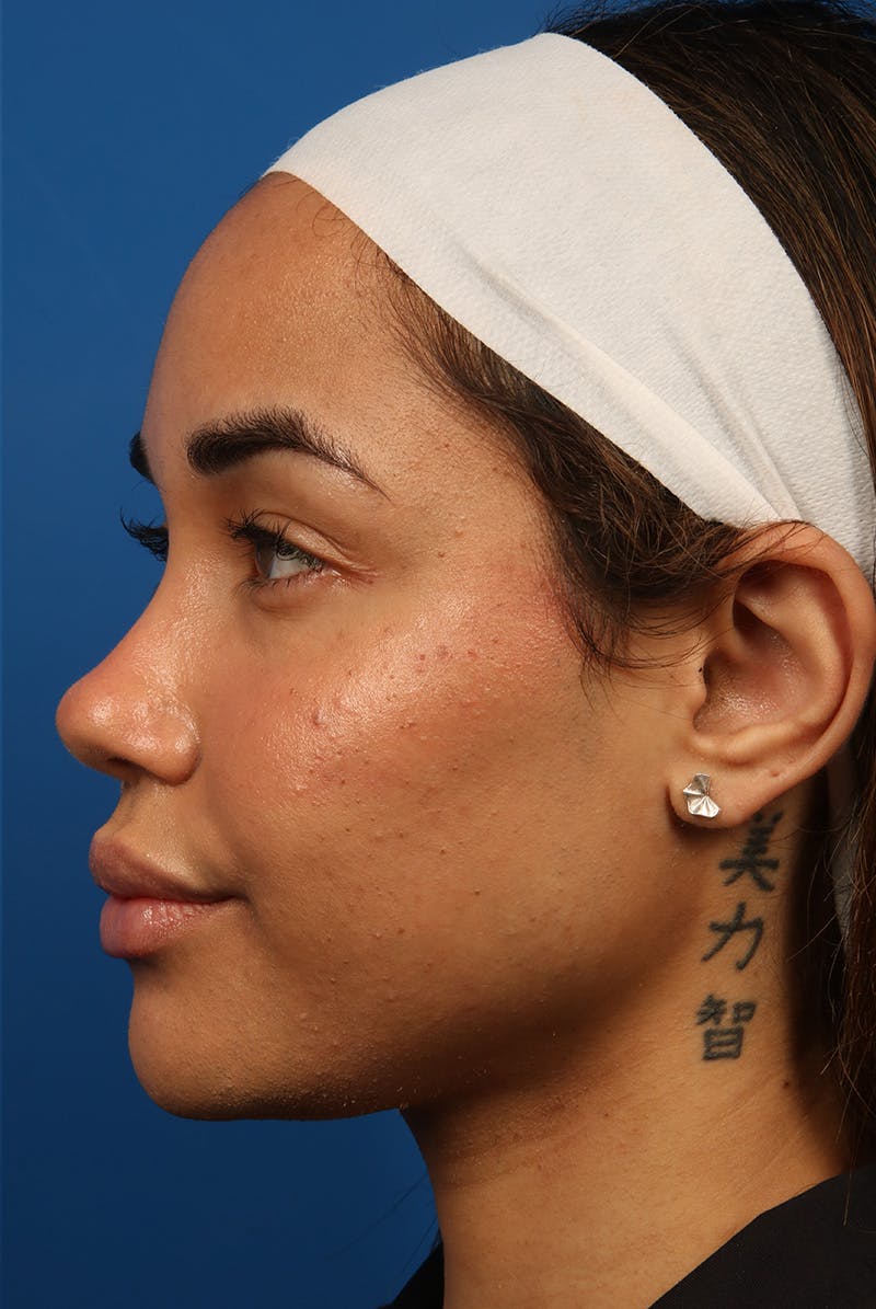 Tear Troughs Before & After Gallery - Patient 301103 - Image 10