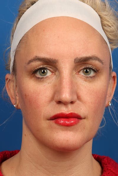 Jawline Before & After Gallery - Patient 479677 - Image 1