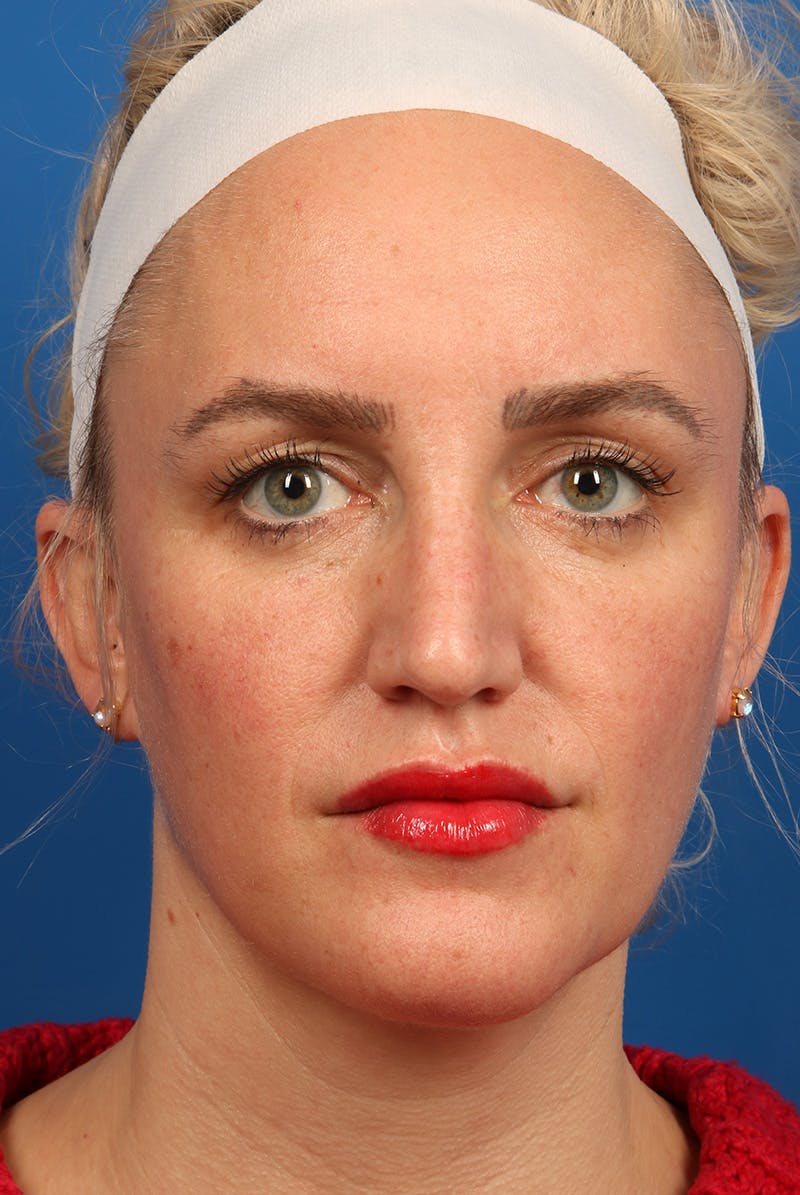 Nose Before & After Gallery - Patient 463536 - Image 1