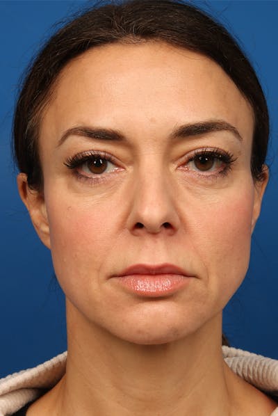 Chin Before & After Gallery - Patient 175499 - Image 1