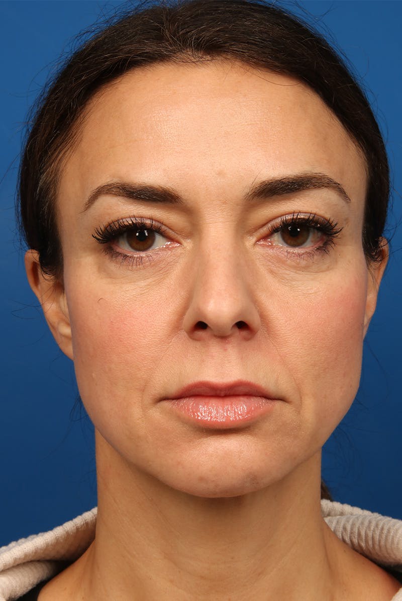 Cheeks Before & After Gallery - Patient 170223 - Image 1