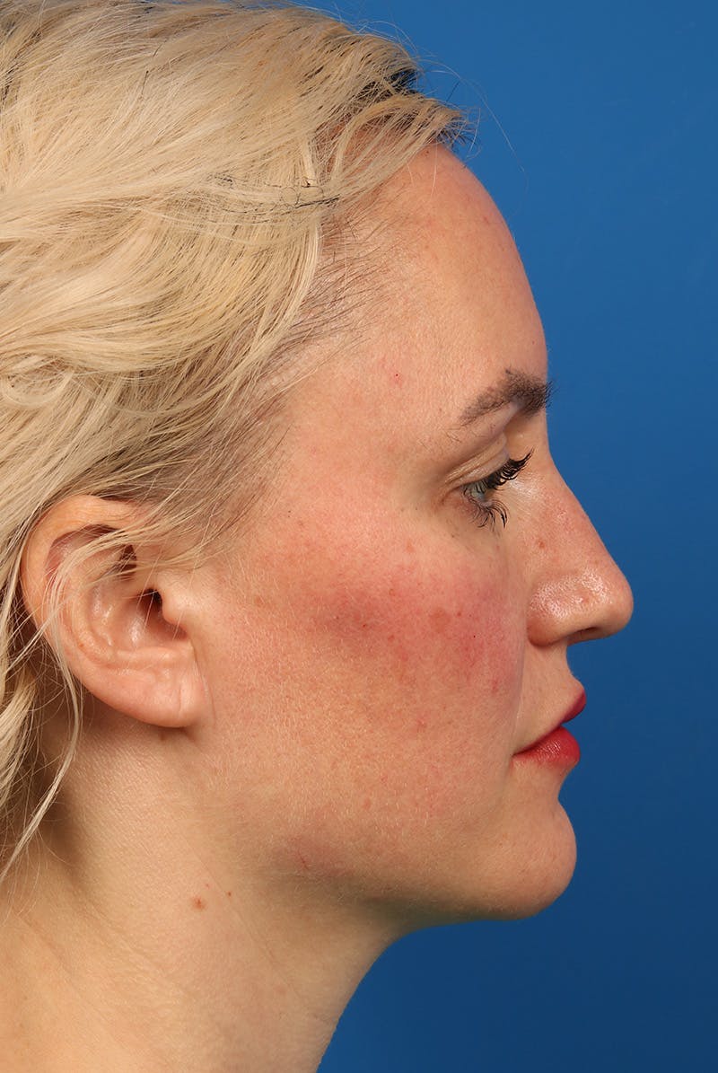 Nose Before & After Gallery - Patient 463536 - Image 6