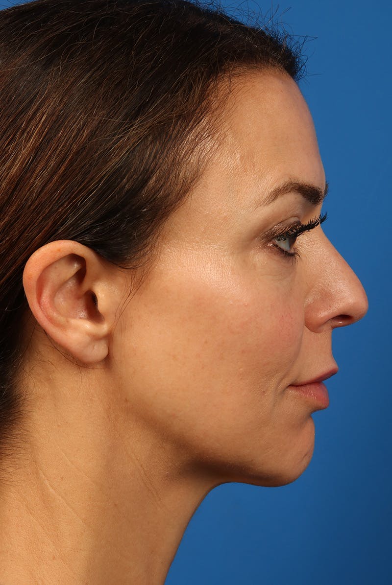 Cheeks Before & After Gallery - Patient 170223 - Image 6