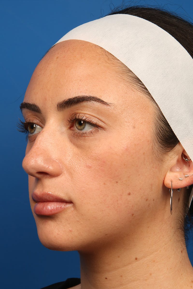 Tear Troughs Before & After Gallery - Patient 349942 - Image 7