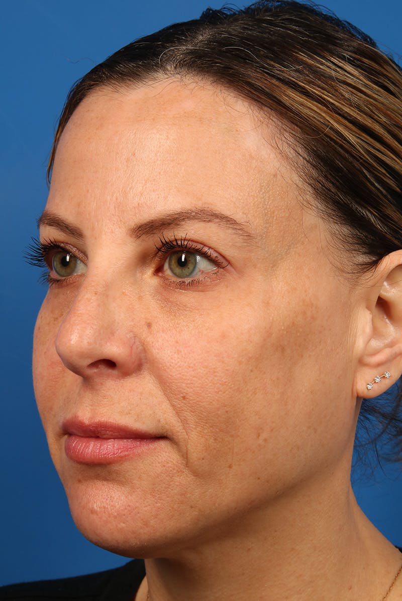 Full Face Before & After Gallery - Patient 284190 - Image 8