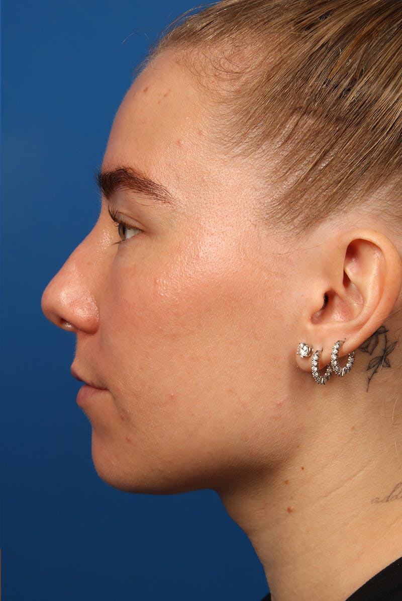 Nose Before & After Gallery - Patient 279270 - Image 9