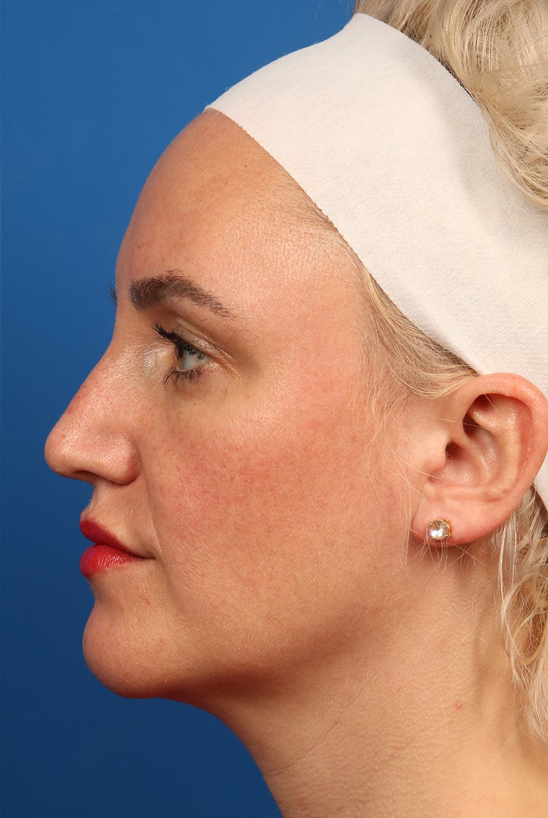 Nose Before & After Gallery - Patient 463536 - Image 9
