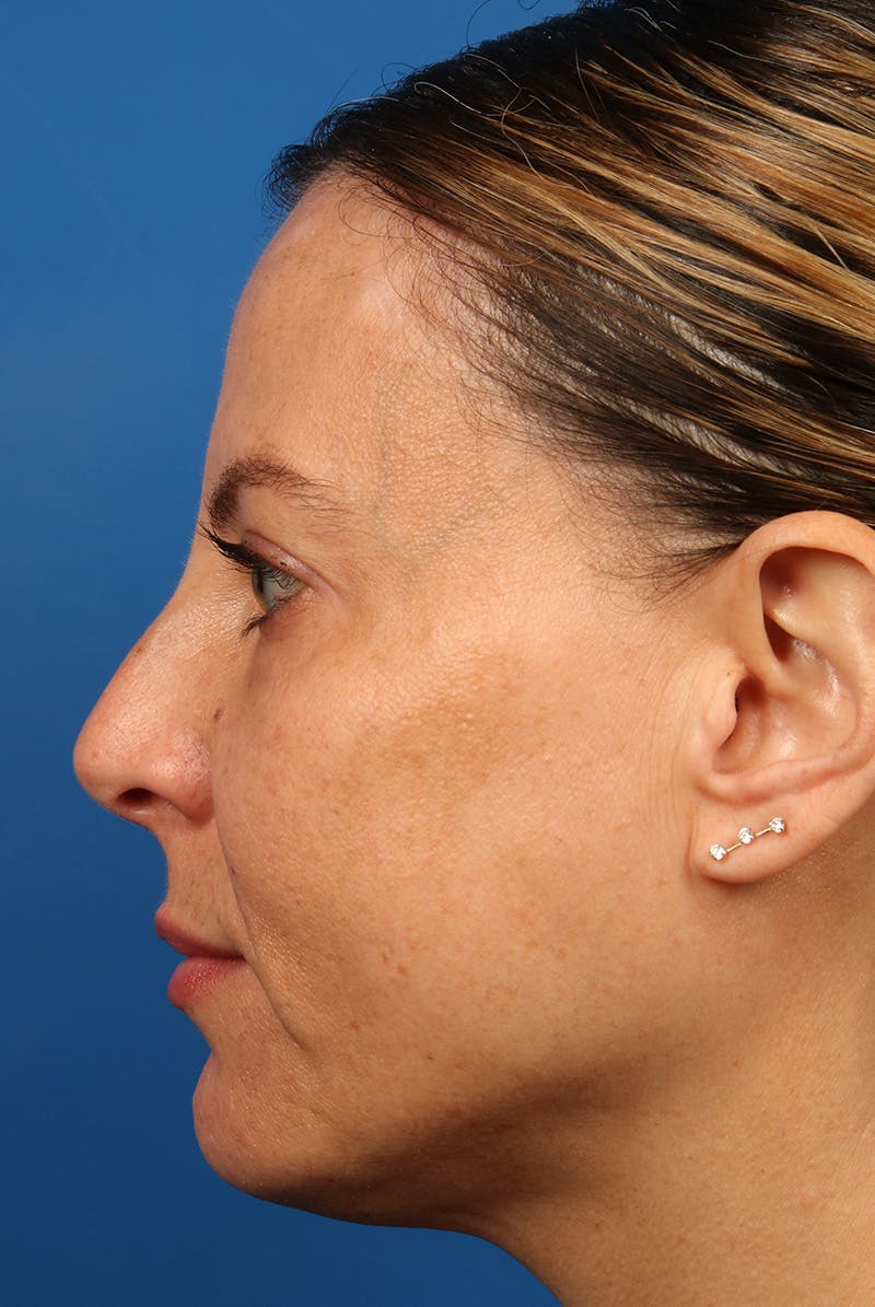 Full Face Before & After Gallery - Patient 284190 - Image 10