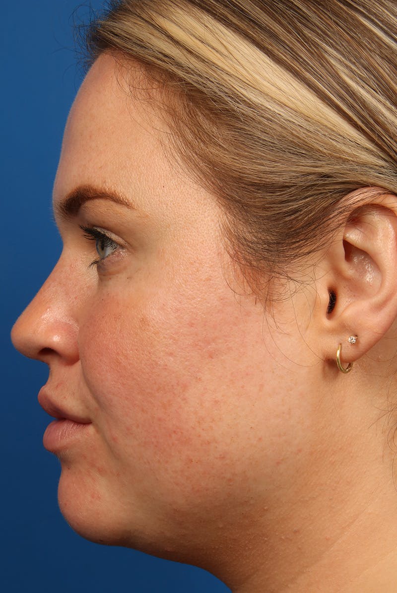 Tear Troughs Before & After Gallery - Patient 216553 - Image 10