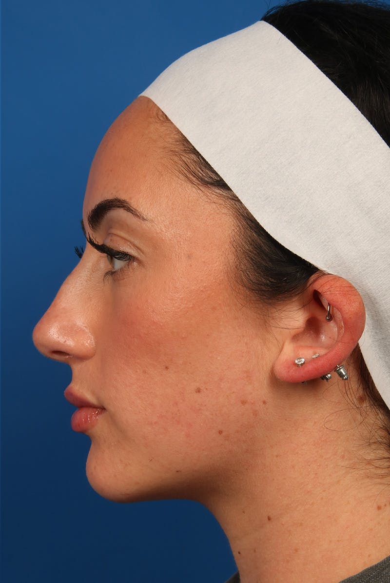 Tear Troughs Before & After Gallery - Patient 349942 - Image 10