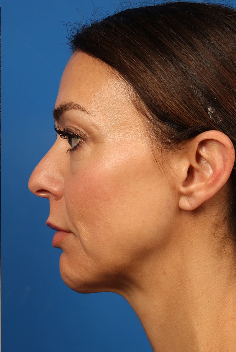 Cheeks Before & After Gallery - Patient 170223 - Image 10