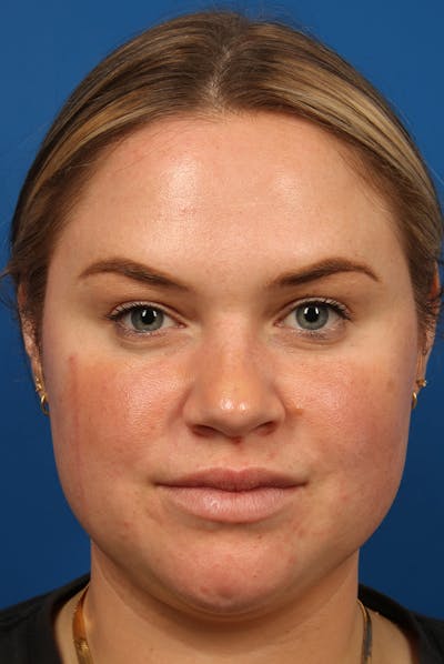 Nose Before & After Gallery - Patient 251525 - Image 2