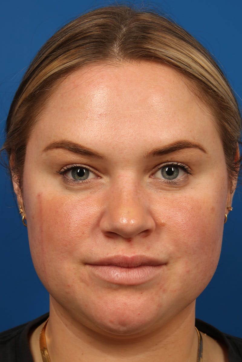 Tear Troughs Before & After Gallery - Patient 216553 - Image 2