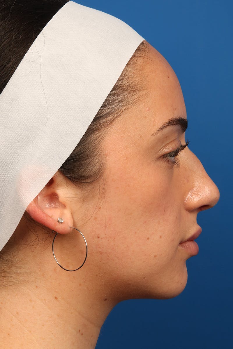 Tear Troughs Before & After Gallery - Patient 349942 - Image 5