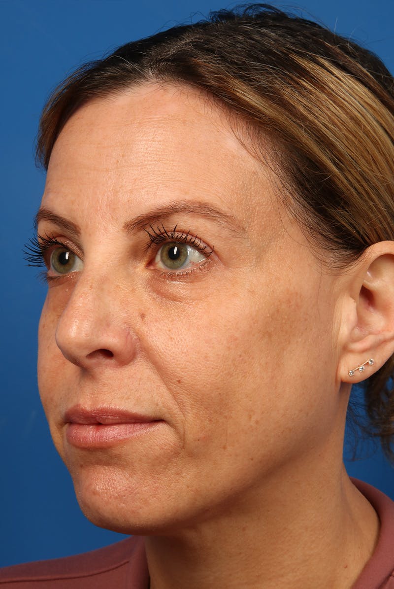 Full Face Before & After Gallery - Patient 284190 - Image 7