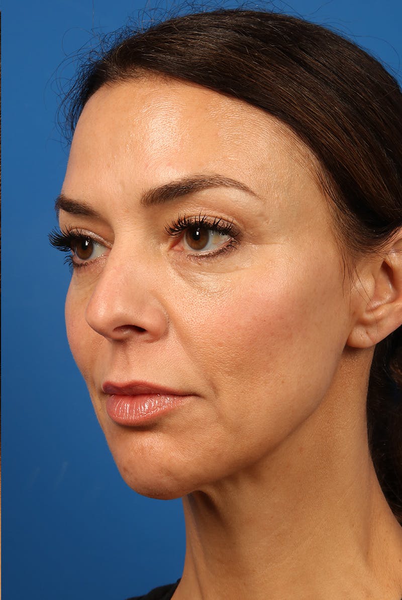 Cheeks Before & After Gallery - Patient 170223 - Image 8