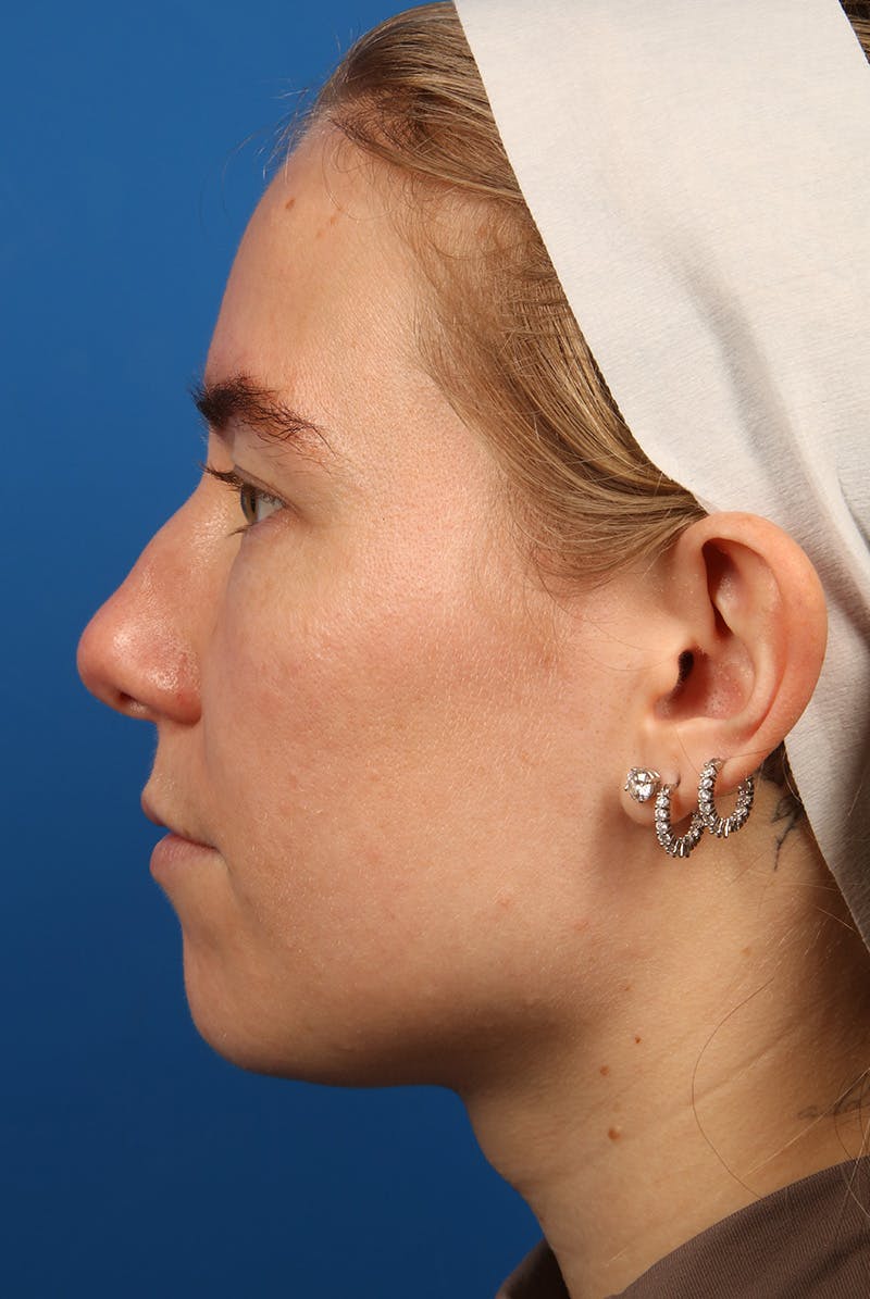 Nose Before & After Gallery - Patient 279270 - Image 10