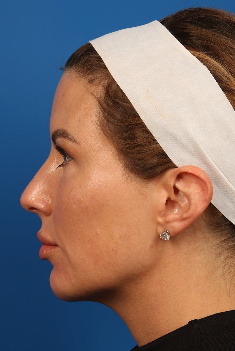 Tear Troughs Before & After Gallery - Patient 399893 - Image 10