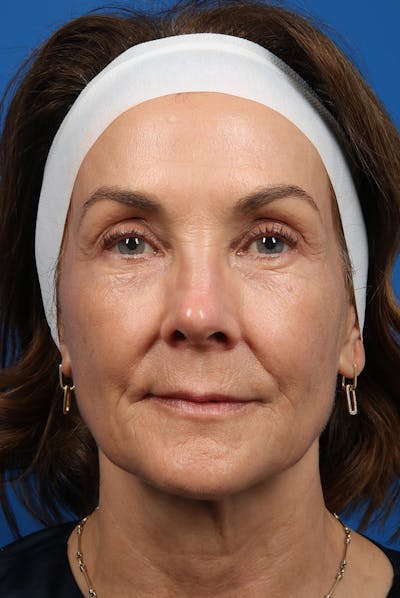 Laser Skin Resurfacing Before & After Gallery - Patient 320386 - Image 1