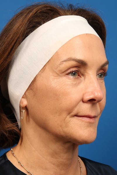 Microneedling Before & After Gallery - Patient 265615 - Image 2