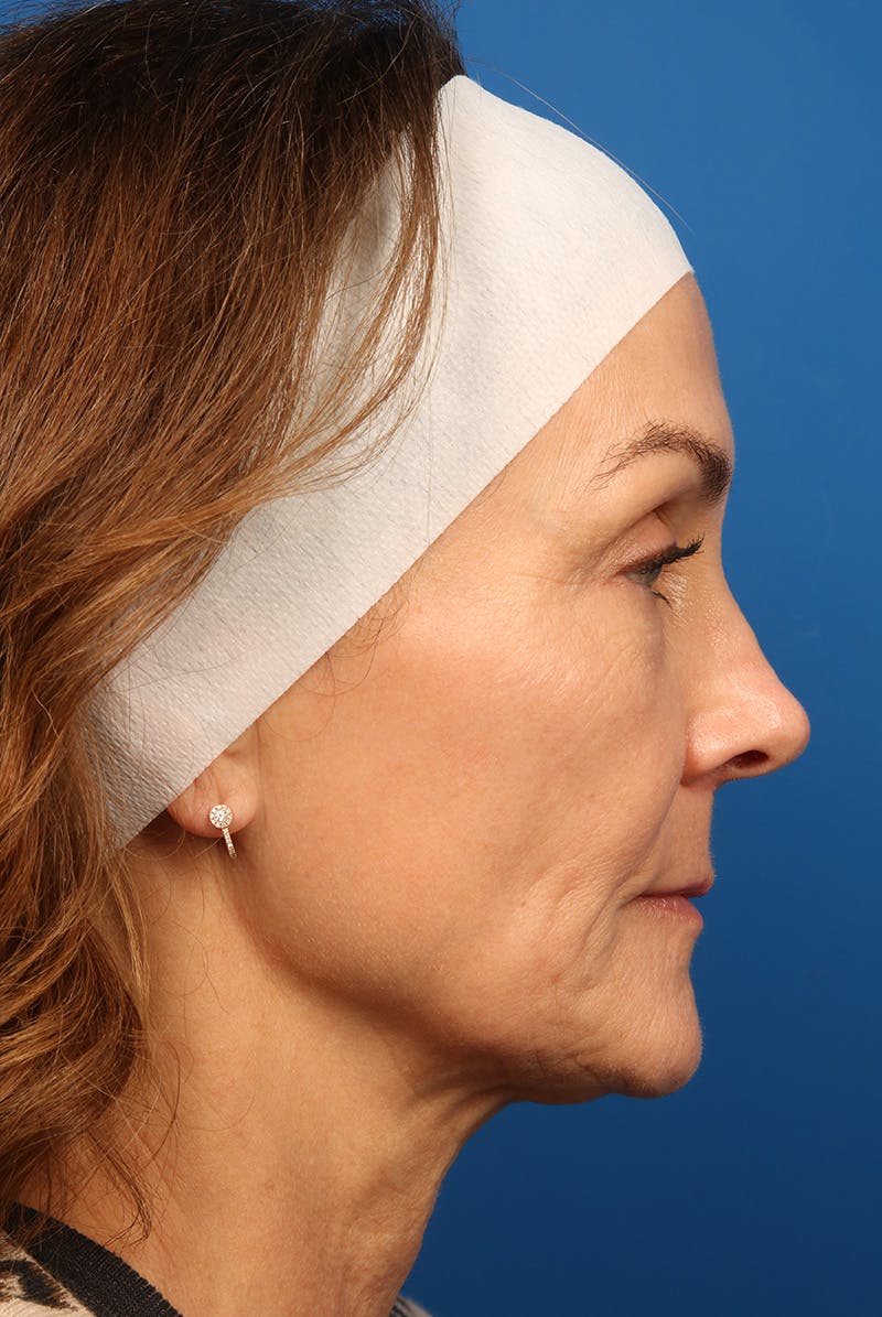 Laser Skin Resurfacing Before & After Gallery - Patient 320386 - Image 5