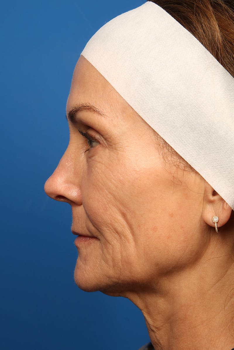Laser Skin Resurfacing Before & After Gallery - Patient 320386 - Image 10