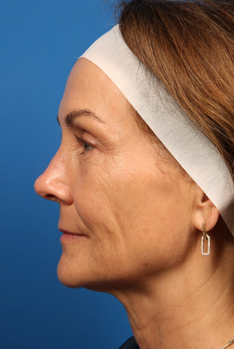 Laser Skin Resurfacing Before & After Gallery - Patient 320386 - Image 9