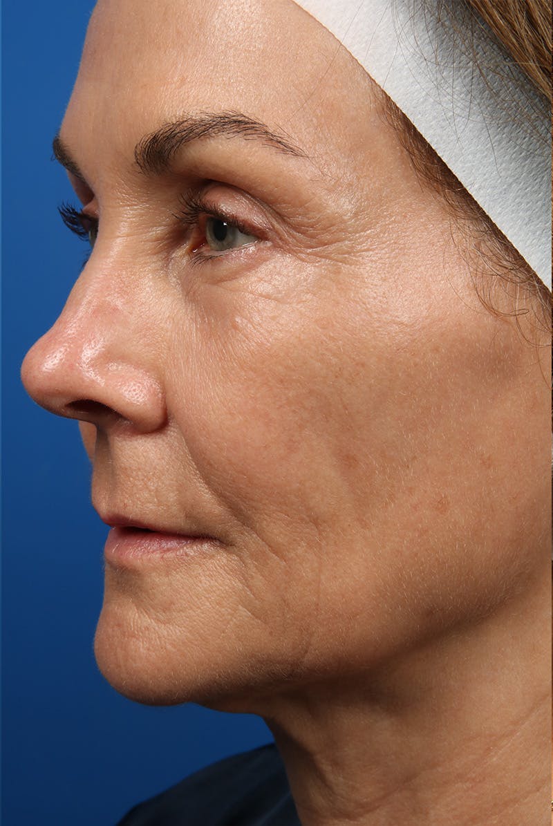 Laser Skin Resurfacing Before & After Gallery - Patient 320386 - Image 12