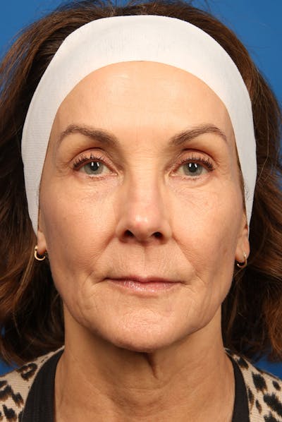Laser Skin Resurfacing Before & After Gallery - Patient 320386 - Image 2