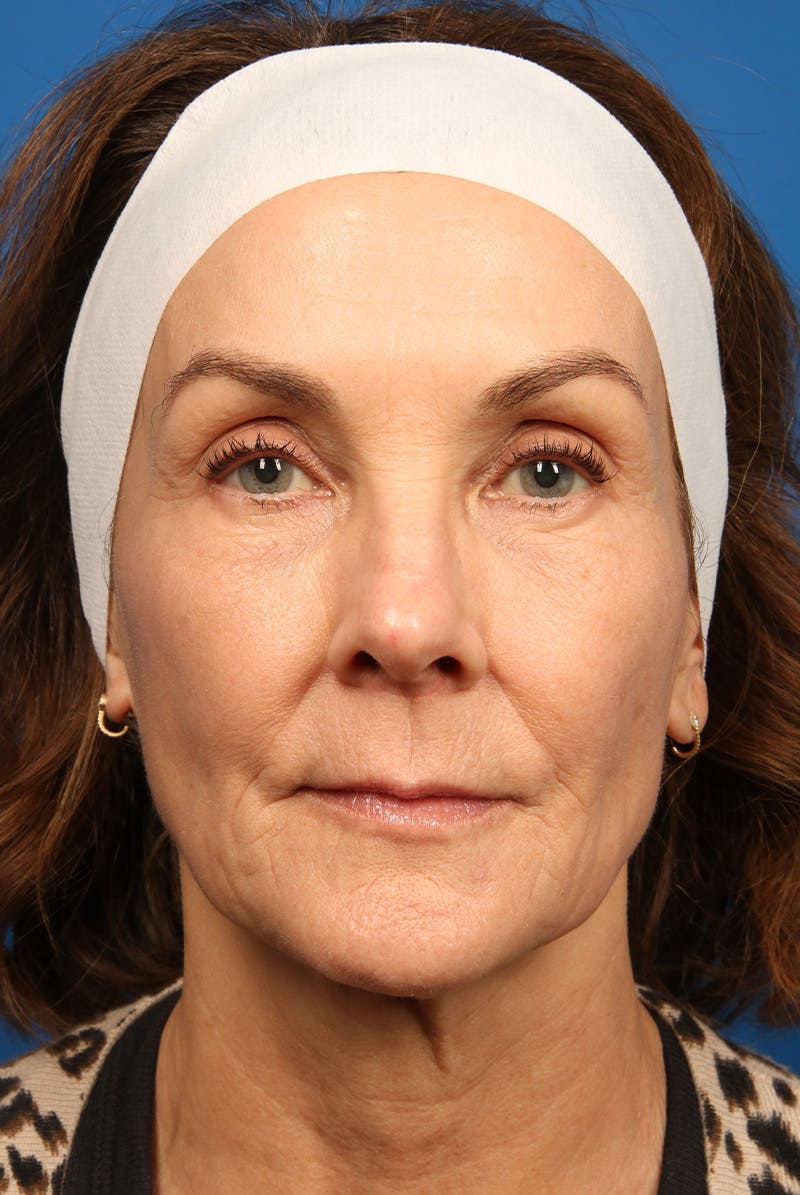 Laser Skin Resurfacing Before & After Gallery - Patient 320386 - Image 2