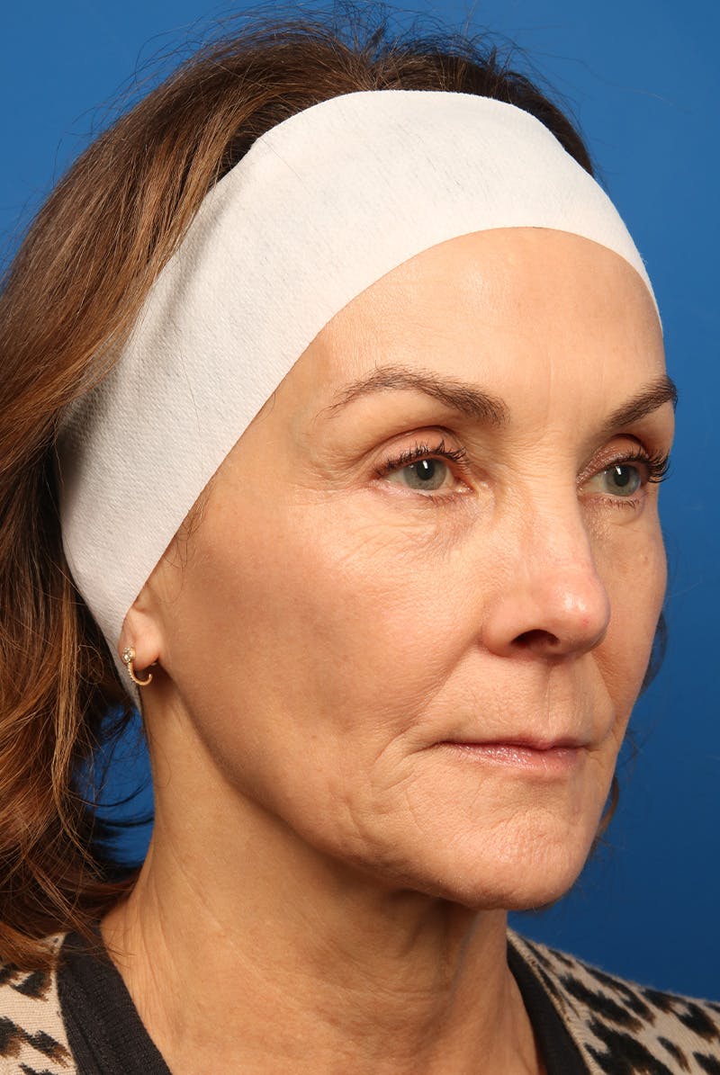 Laser Skin Resurfacing Before & After Gallery - Patient 320386 - Image 3