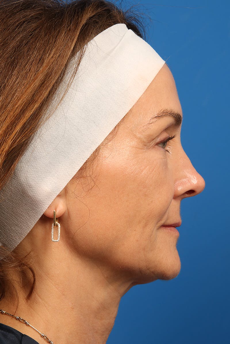 Laser Skin Resurfacing Before & After Gallery - Patient 320386 - Image 6