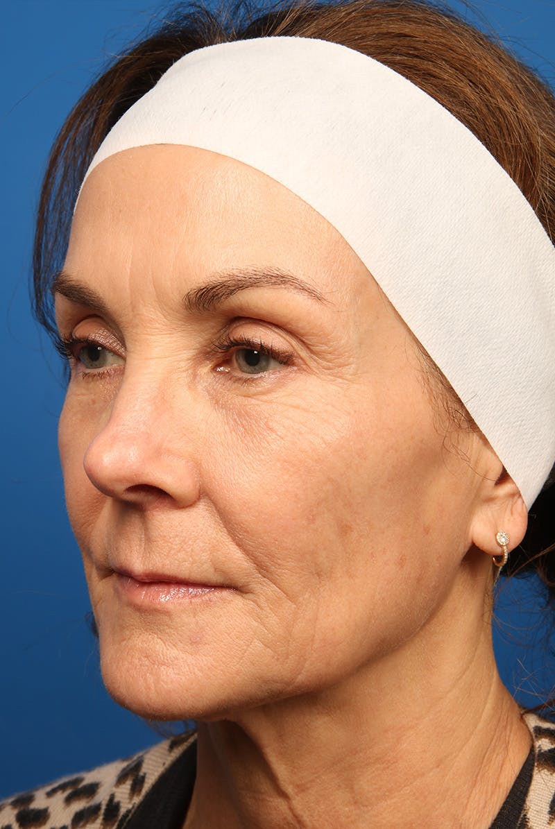 Laser Skin Resurfacing Before & After Gallery - Patient 320386 - Image 7