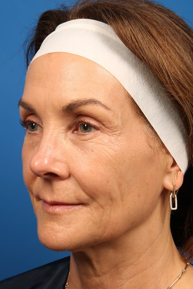 Laser Skin Resurfacing Before & After Gallery - Patient 320386 - Image 8