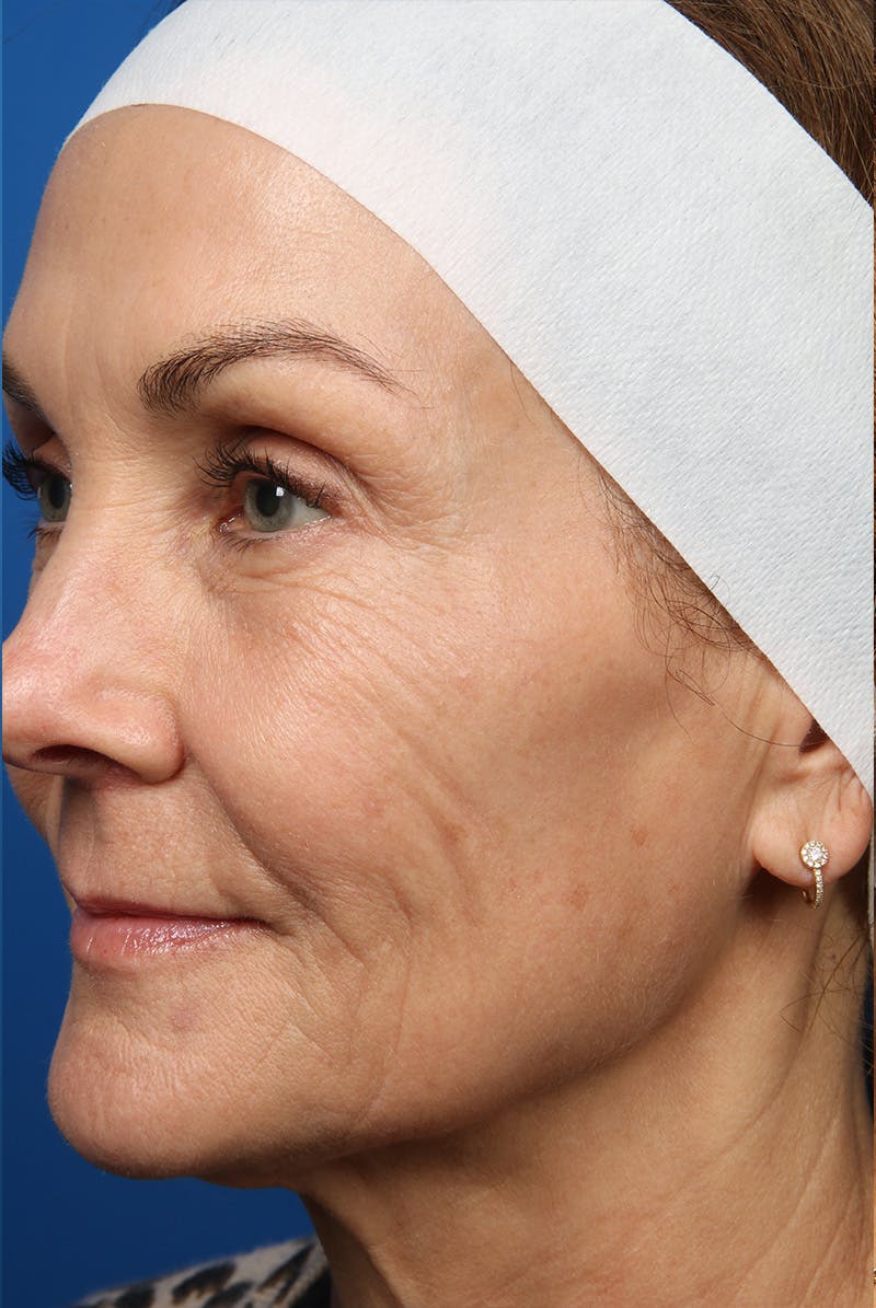Laser Skin Resurfacing Before & After Gallery - Patient 320386 - Image 13