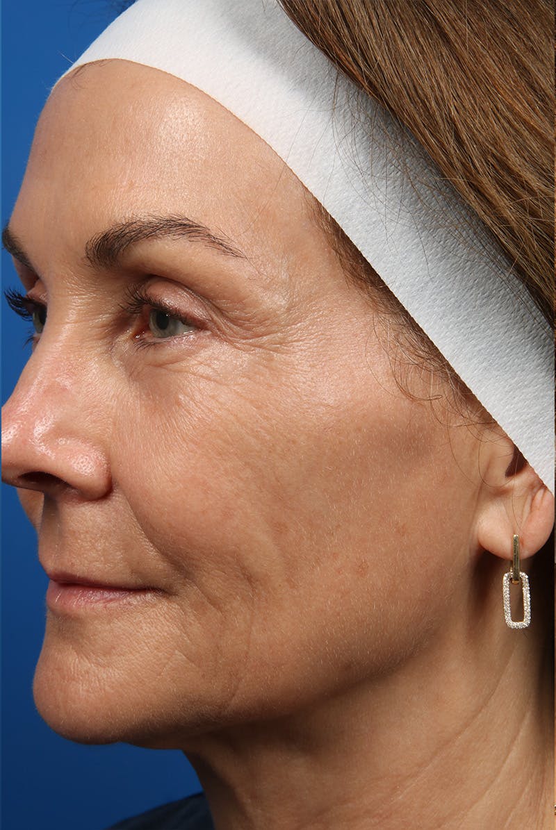 Laser Skin Resurfacing Before & After Gallery - Patient 320386 - Image 14