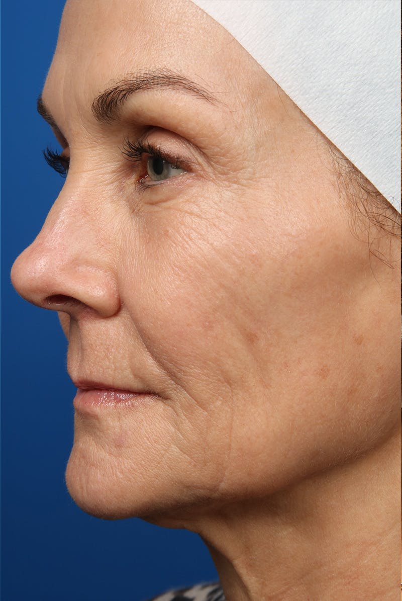 Laser Skin Resurfacing Before & After Gallery - Patient 320386 - Image 11