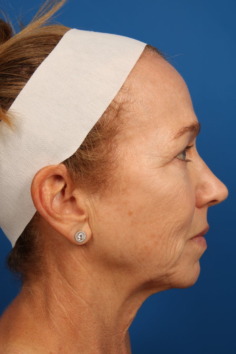 Laser Skin Resurfacing Before & After Gallery - Patient 148953 - Image 5