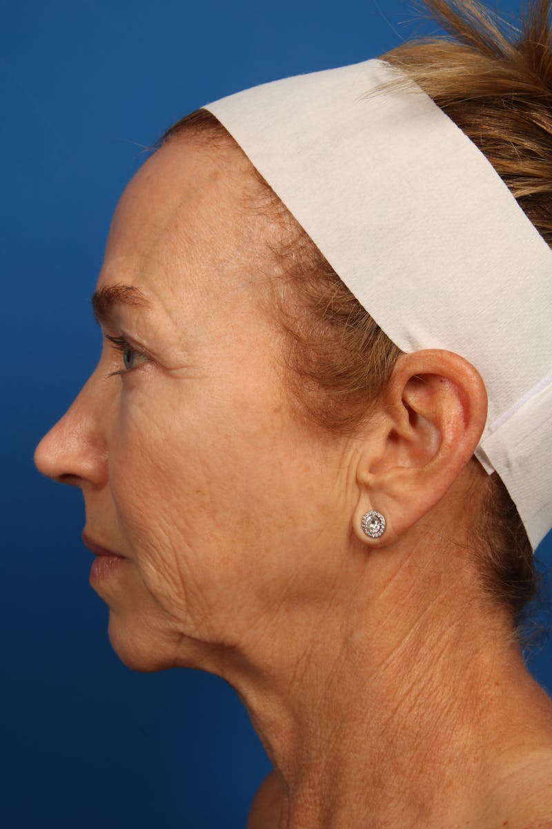 Laser Skin Resurfacing Before & After Gallery - Patient 148953 - Image 9