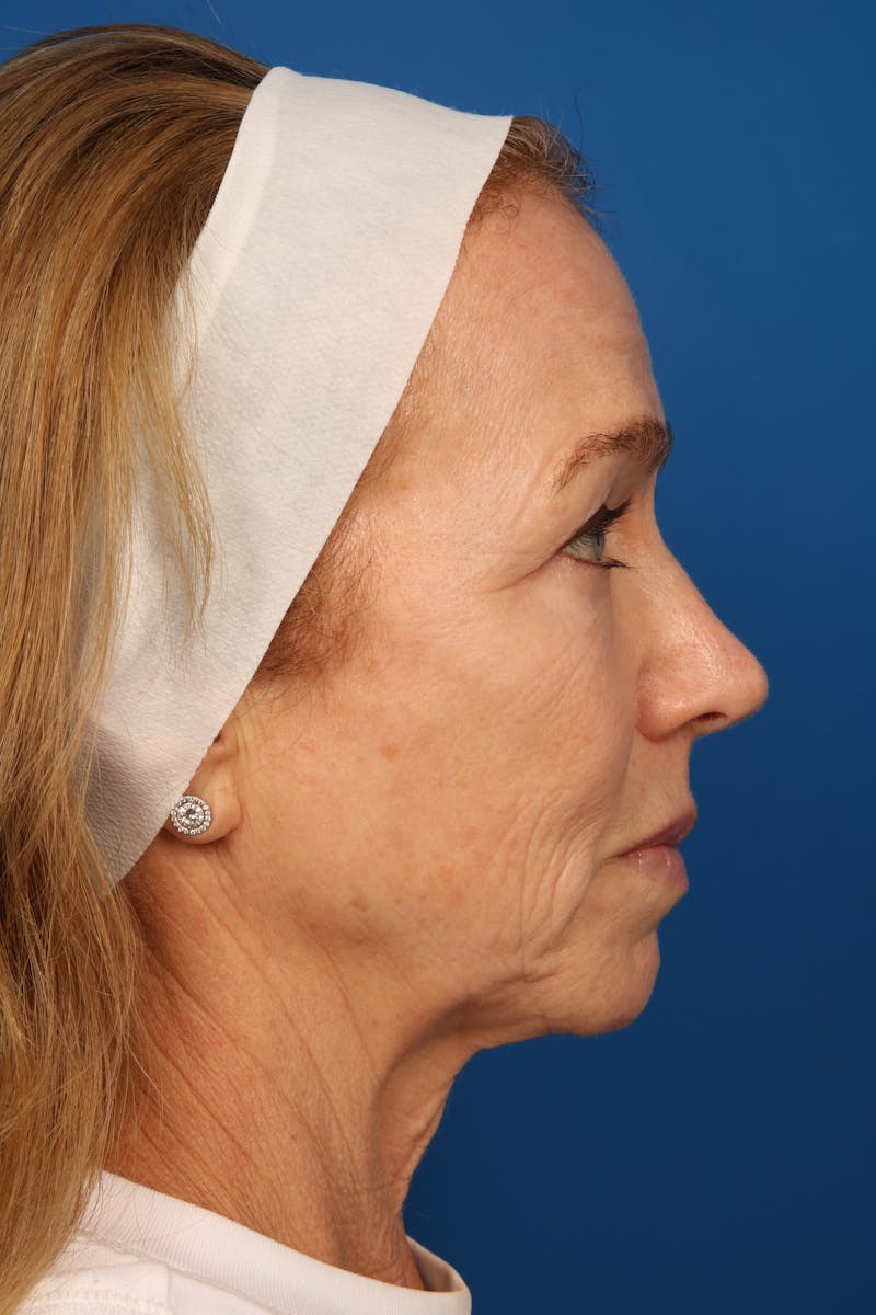 Laser Skin Resurfacing Before & After Gallery - Patient 148953 - Image 6